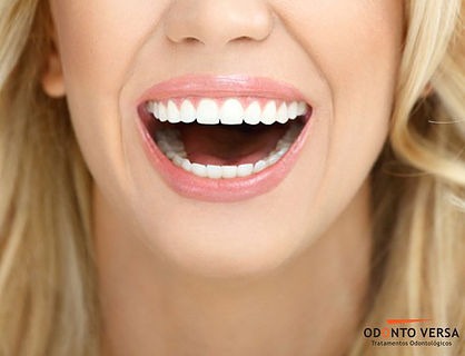 Facetas e Lentes de Contato em Porcelana. Seus sorriso muito mais bonito