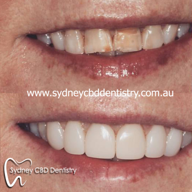 Composite_veneer.jpg