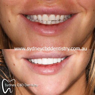 Sydney_veneer.jpg