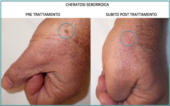 Studio Medico Serini | Cheratosi seborroica DAS.jpg