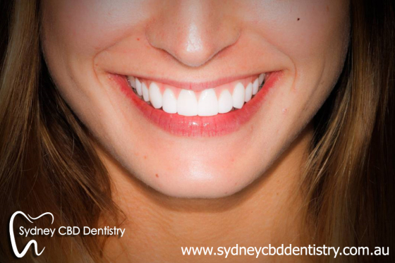 Dental_veneer.jpg