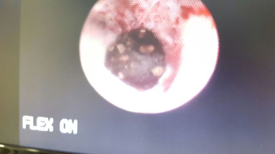 Renoscopia flexible y laser holmium