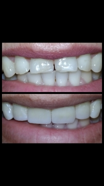 Lente de contato apenas nos 4 incisivos. Cor idêntica ao dente canino da paciente