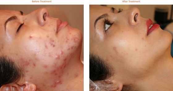 ACNE TREATMENT