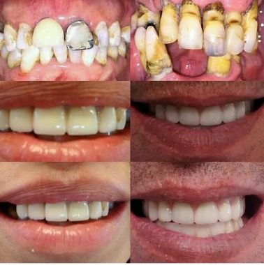 Evolución tratamiento de 2 casos. Fotografías superiores muestran estado inicial de ambos pacientes, y fotografías inferiores muestras tratamientos finalizados. En paciente lado izquierdo se realizaron endodoncias y respectivas PFU Y PFP en sector anterior superior y PPR para sector posterosuperior. En paciente lado derecho se  realizaron prótesis total superior e inferior.