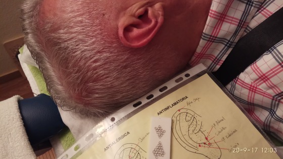 Auriculoterapia (bajar inflamación) extracción dental