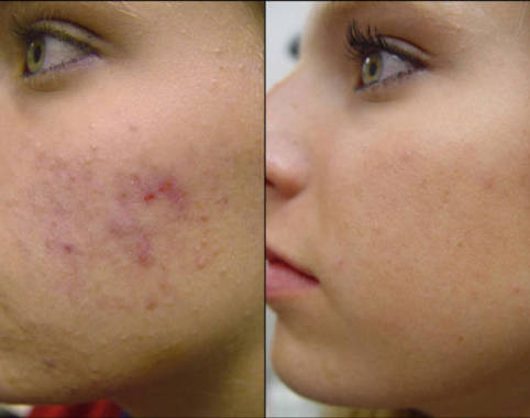 Tratamento para Acne
