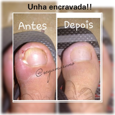 Unha encravada 