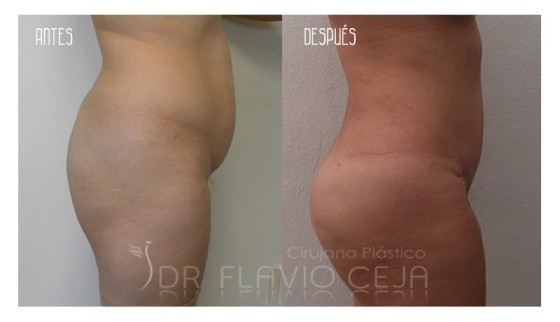 Aumento de Gluteo