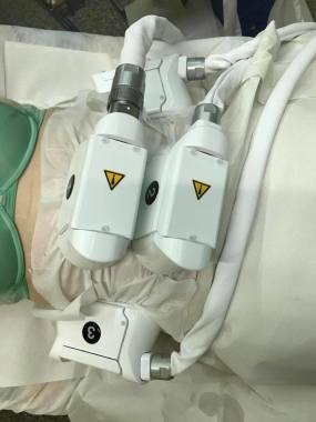 Traitement de cryolipolyse en cours