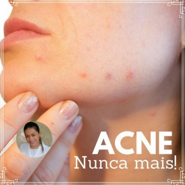 Tratamento para acne