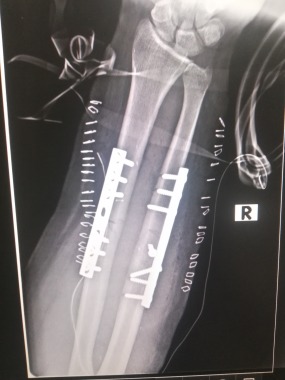 Fractura diafisis de radio y cubitotx qx placas Dcp