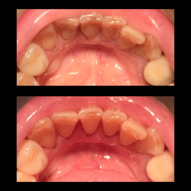 Destartraje supragingival (limpieza)