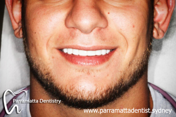 Parramatta_tooth_whitening.jpg