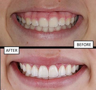 veneer-after.jpg