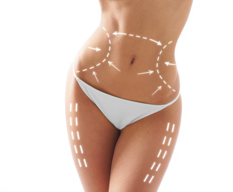 Abdominoplastia