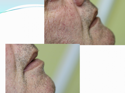 Foto a dx: paziente edentulo. Foto  a sx: paziente riabilitato con protesi mobile