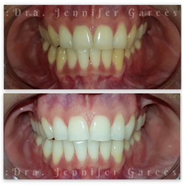 Blanqueamiento Dental
