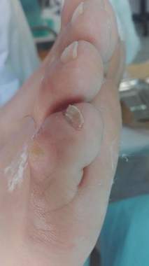 Heloma marginal  antes de la atención