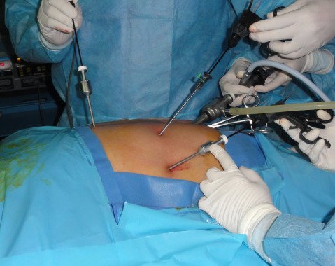 CIRUGIA DE VESICULA POR LAPAROSCOPIA