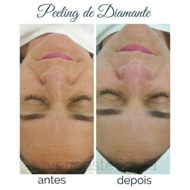 Peeling de Diamante