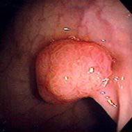 TUMOR DE COLON