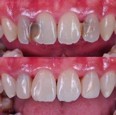 Restauraciones de composite