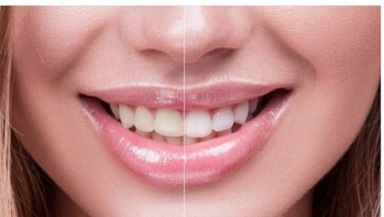 Blanqueamiento dental