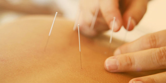 Acupuntura para dor na coluna