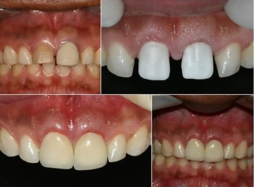 corona en zirconio
