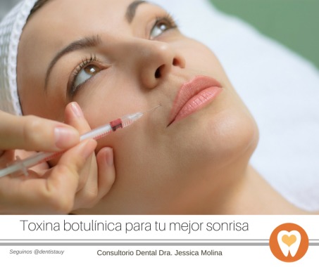 En las sonrisas gingivales, se expone mas de 2mm de encía al sonreir. Se utiliza la toxina botulinica para reducir la elevación del labio superior y así evitar tratamientos mas complejos como gingivectomias (cirugía en la encía)  www.dentistauy.com