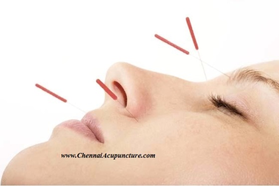 Cosmetic Acupuncture Treatment Chennai