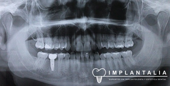 Valoración de nuestros pacientes con implantes