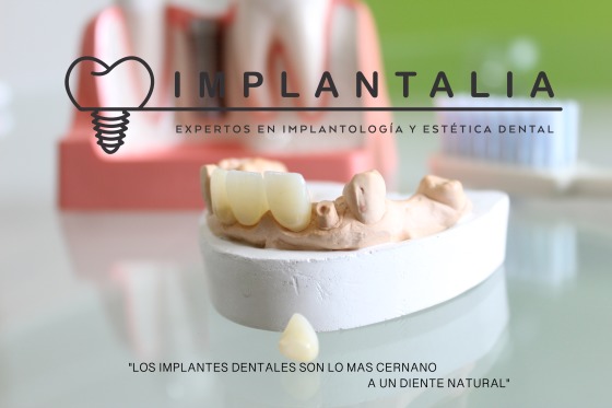 Coronas sobre implantes. Estetica dental