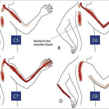 Alteración sensitiva columna cervical 