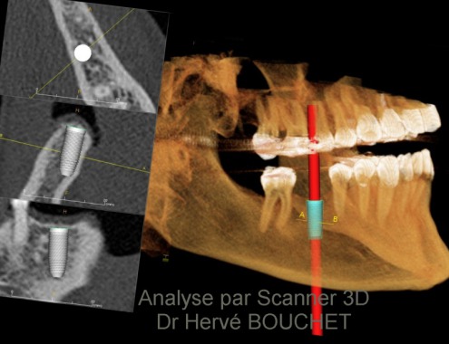 Analyse par logiciel de planification implantaire 3D