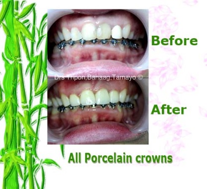All Porcelain crowns