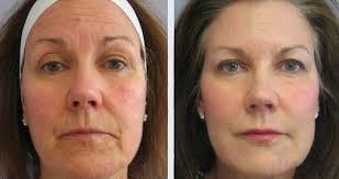 Tratamiento de rejuvenecimiento facial (1 sesión)