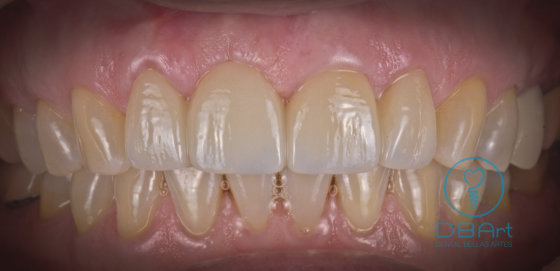 Sra. R. Sanchez. Puente de Zirconia