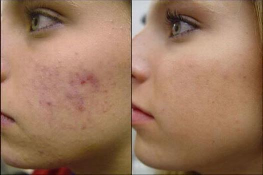 Tratamento de acne e cicatrizes