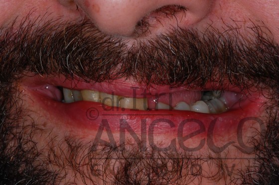 paziente con grave compromissione del proprio sorriso
