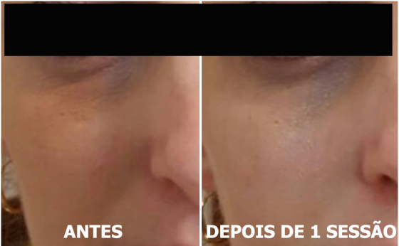 Acupuntura estética