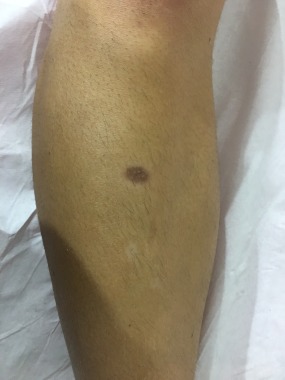 Fotodepilacao a laser diodo