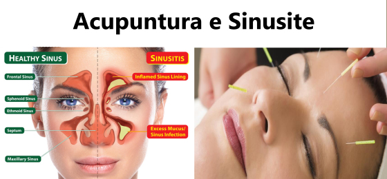 Tratamento de Sinusite com Acupuntura