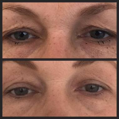 Ooglidcorrectie plasma Soft surgery
