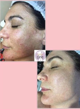 Peeling amazônico + célula tronco!