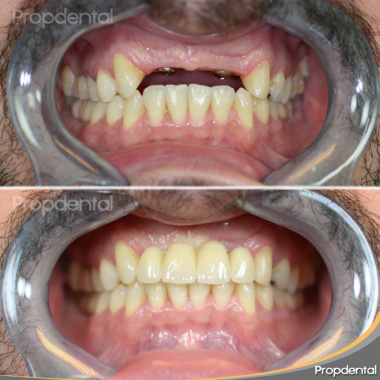 IMPLANTES Y PROTESIS FIJA