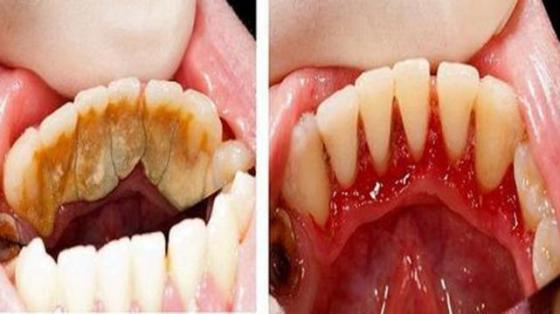 LIMPIEZA DENTAL