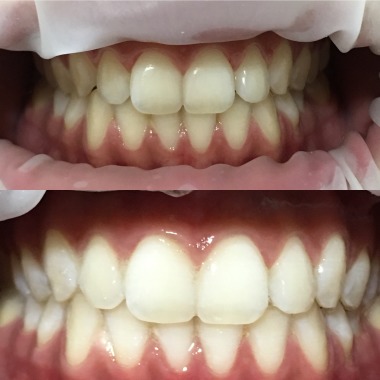 Blanqueamiento Dental Led 