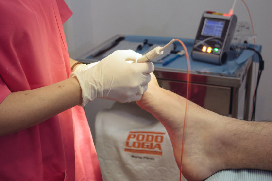 Tratamiento Laser Onicomicosis.